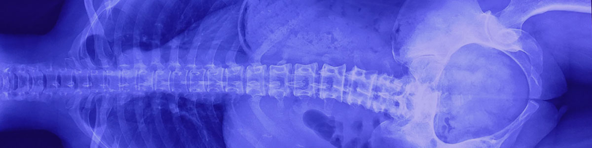 3D Printing Orthopedic Implants