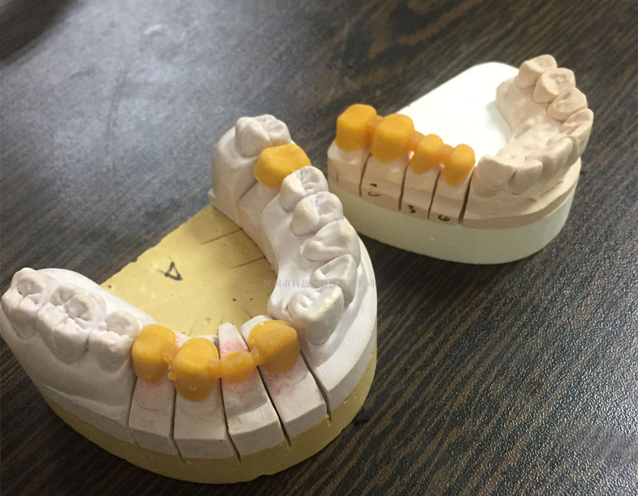 DLP 3D printed dentistry
