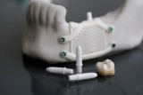 Ceramic 3D printing takes a new step in dental products